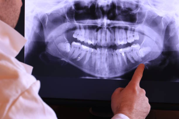Best Emergency Wisdom Teeth Removal in Los Molinos, CA