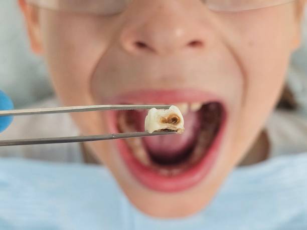 Best Emergency Broken Tooth Repair in Los Molinos, CA
